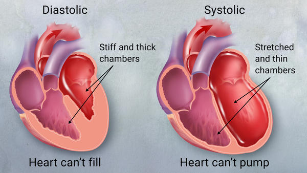 نارسایی قلبی با قدرت پمپاژ طبیعی (کسر جهشی حفظ شده) - مجله علمی ...